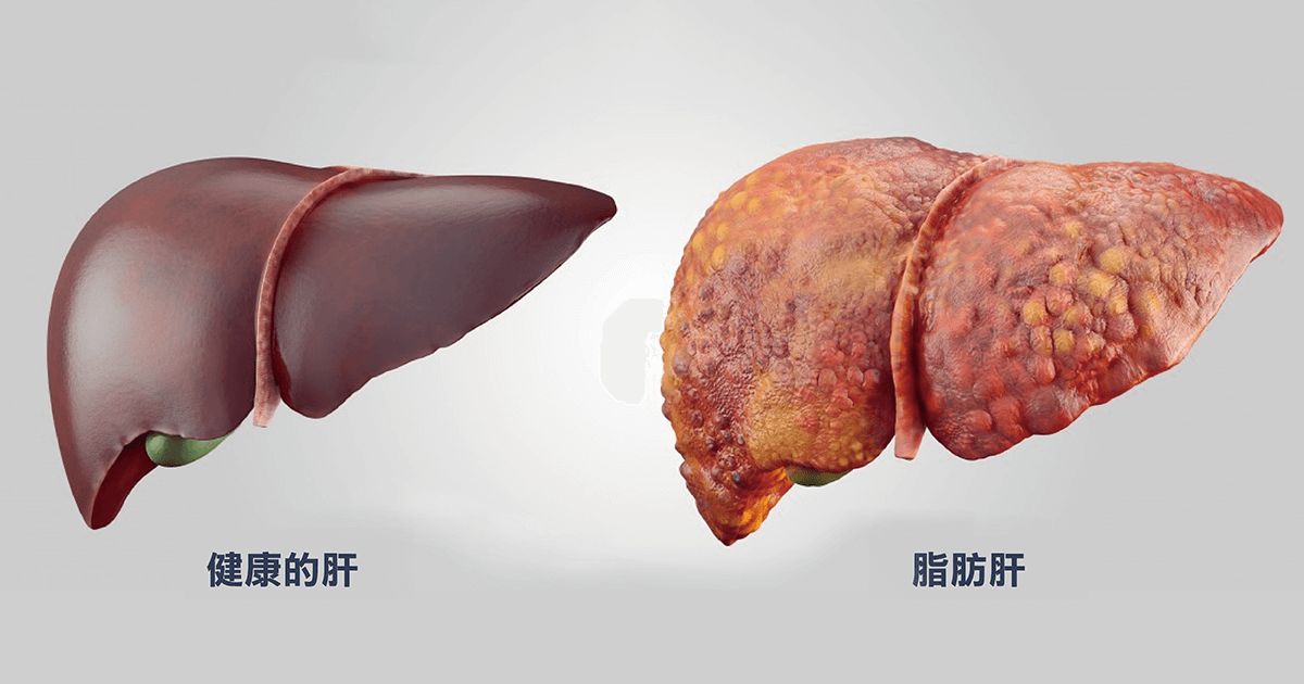 脂肪肝的危害，你不會還不知道吧