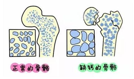 不想讓骨頭變脆，這4件事一定要少做！