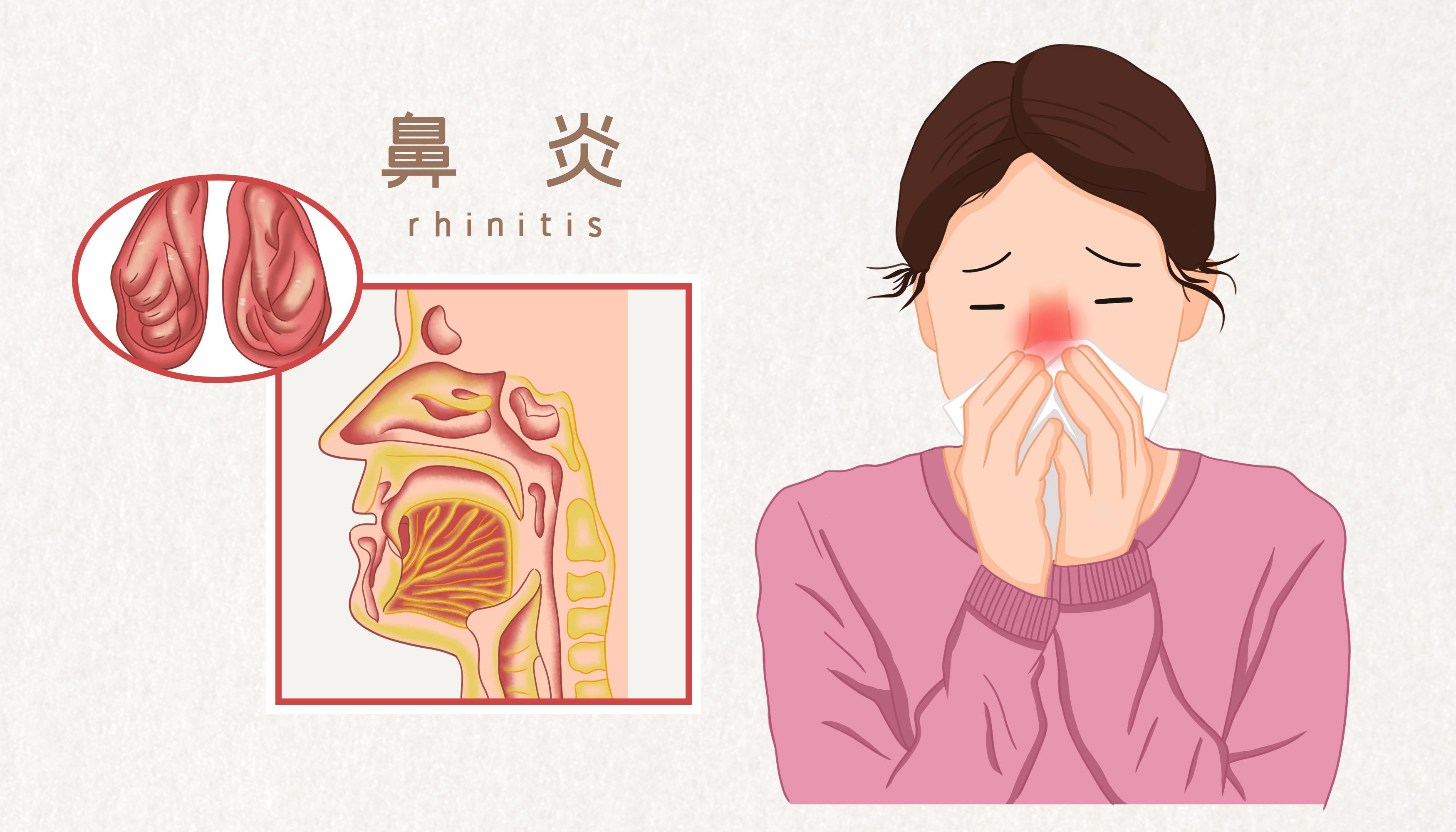 一篇文章帶你了解鼻炎！