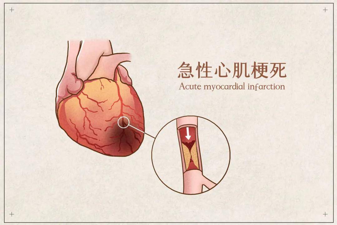 心肌梗死，年輕人應(yīng)該警惕！