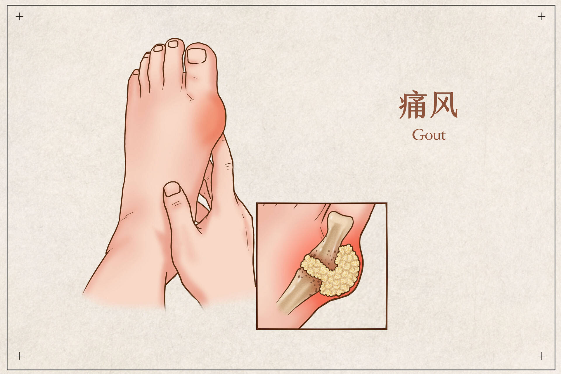 高尿酸、痛風(fēng)，到底能不能吃豆類？